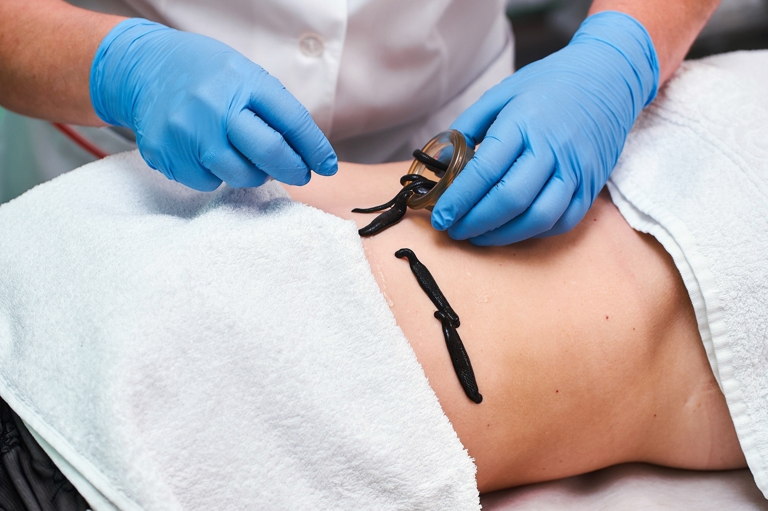 Гирудотерапия